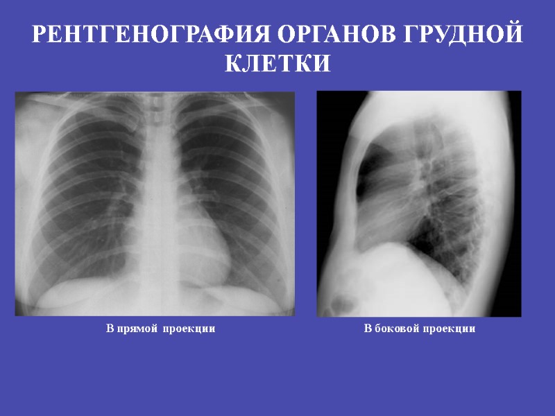 РЕНТГЕНОГРАФИЯ ОРГАНОВ ГРУДНОЙ КЛЕТКИ В прямой проекции В боковой проекции